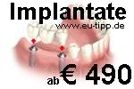 ZAHN-Behandlung CZ -günstiger als Ungarn/Polen- Implantate Euro 490