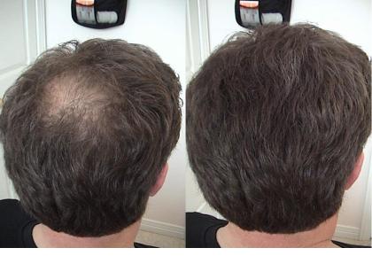 Lichtes dünnes Haar Haarprobleme Haarausfall Hairfor2 hilft .