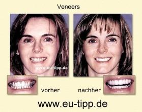NEUE ZÄHNE günstiger in CZ - Implantate Euro 490