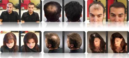 Lichtes Haar Lichte Stellen Dünnes Haar Haarprobleme Haarverlust Haarausfal