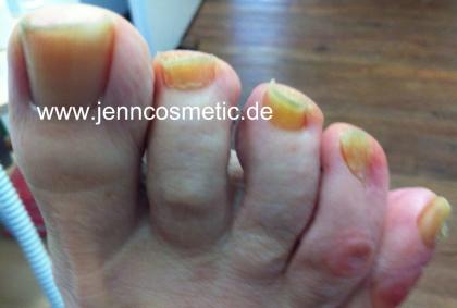 Fußnagelpilz Blauer Zehnagel Lösen Sie Ihre all Fußnagel Probleme mit dem Fußn
