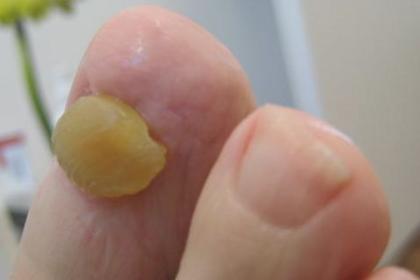 Was tun gegen Fußnagelpilz 1x kostenfreie med. Fußpflege von Jenn Cosmetic.