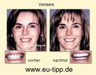ZAHN-Behandlung CZ -günstiger als Ungarn- Implantate ab 490 Euro