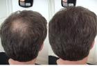 Lichtes dünnes Haar Haarprobleme Haarausfall Hairfor2 hilft .