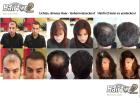 Lichtes Haar Dünnes Haar Haarprobleme Haarverlust Haarausfall Alopezie Hai