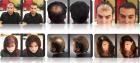 Lichtes Haar Lichte Stellen Dünnes Haar Haarprobleme Haarverlust Haarausfal