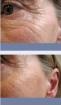 Faltenfrei ohne Spritzen ohne Schmerzen ohne Hormone