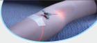 Lasergeräte für Wundheilung