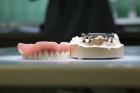 Implantatgetragene stegreitende herausnehmbare Deckprothese